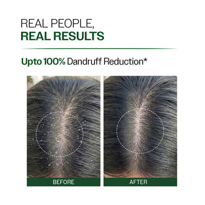 Anti Dandruff Shampoo | With Salicylic Acid, Piroctone Olamine & Biotin